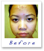 Detox Therapy Spa Tucson Signature Facial Blemish Control Acne Before